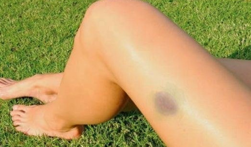 Médicos alertam: algumas manchas escuras que aparecem no corpo podem ser sinais de… Ver mais