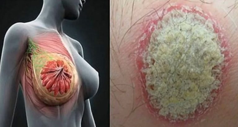 FIQUE ATENTO a 7 sinais que o corpo AVISA que pode estar com CÂNCER… Ver mais