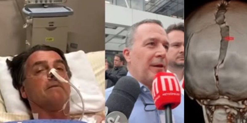 URGENTE: Bolsonaro sofreu um traumatismo craniano e vai ter q… Ver mais